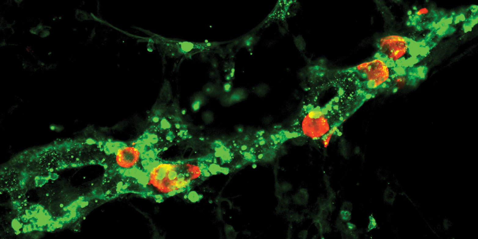 Lymph vessels in the lungs (green) increase the spread of metastatic melanoma cells (red). (Image: Science Advances / Michael Detmar Group)