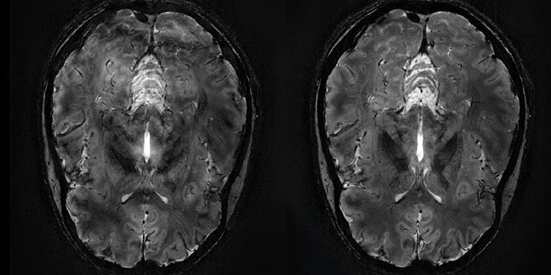 Vergrösserte Ansicht:  Im Vergleich: Das MRI-Bild ohne die Verwendung einer Dynamic Field Kamera mit einigen Bildstörungen (links) und ein im Nachhinein korrigiertes Bild unter der Verwendung der neuen Kamera (rechts). (Bild: Skope)