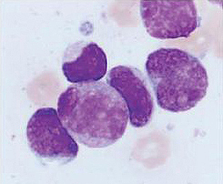 Krebsimmuntherapie unter dem Mikroskop: In der Bildmitte attackieren drei Killerzellen (violett, kleiner) eine Krebszelle (violett, grösser; hier im Bild sind Leukämiezellen). (Bild: Schliemann et al.: Cancer Immunol Res 2015, 3: 547)