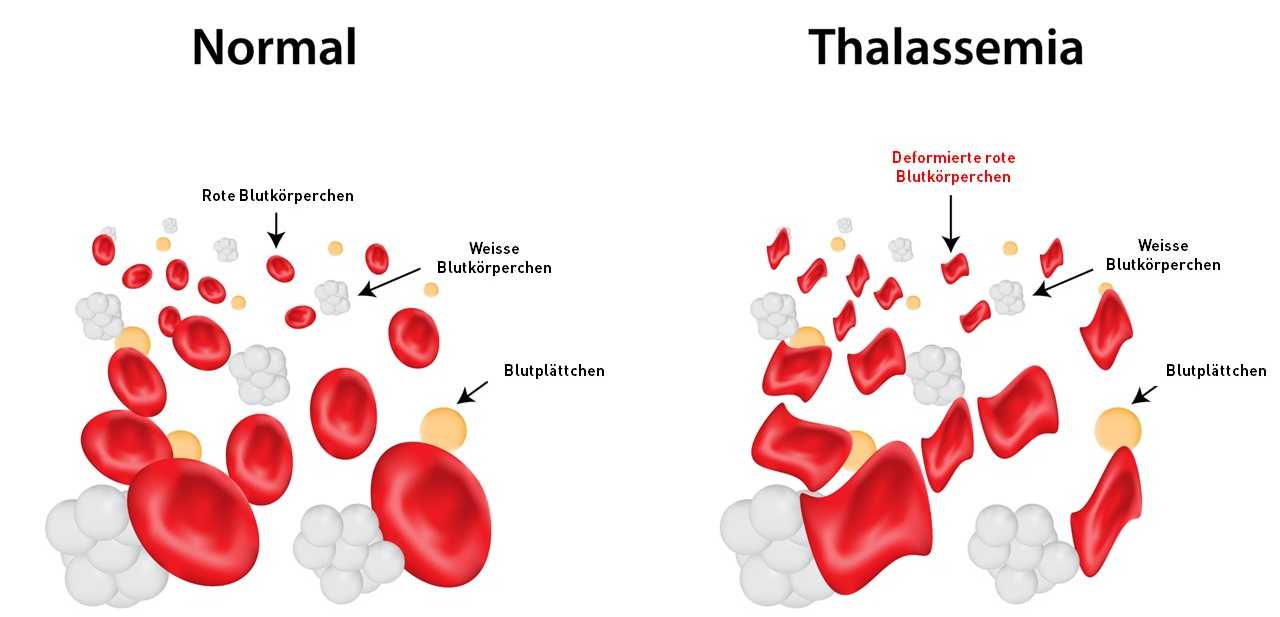 Vergrösserte Ansicht: Der Unterschied zwischen den korrekt funktionierenden roten Blutkörperchen und denen mit einer Fehlfunktion.
