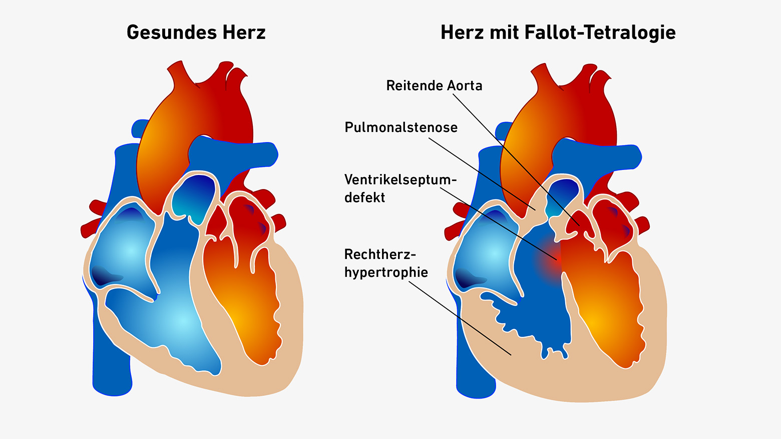 Vergrösserte Ansicht: Schematische Darstellung eines gesunden Herzens neben einem Herzen mit Fallot-Tetralogie, bei welchem die Trennwand zwischen den beiden Herzkammern ein Loch aufweist.