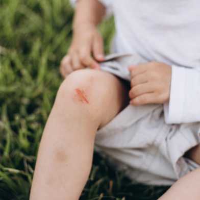Kind, welches eine Schürfwunde am Knie hat. Es sitzt im Gras. 