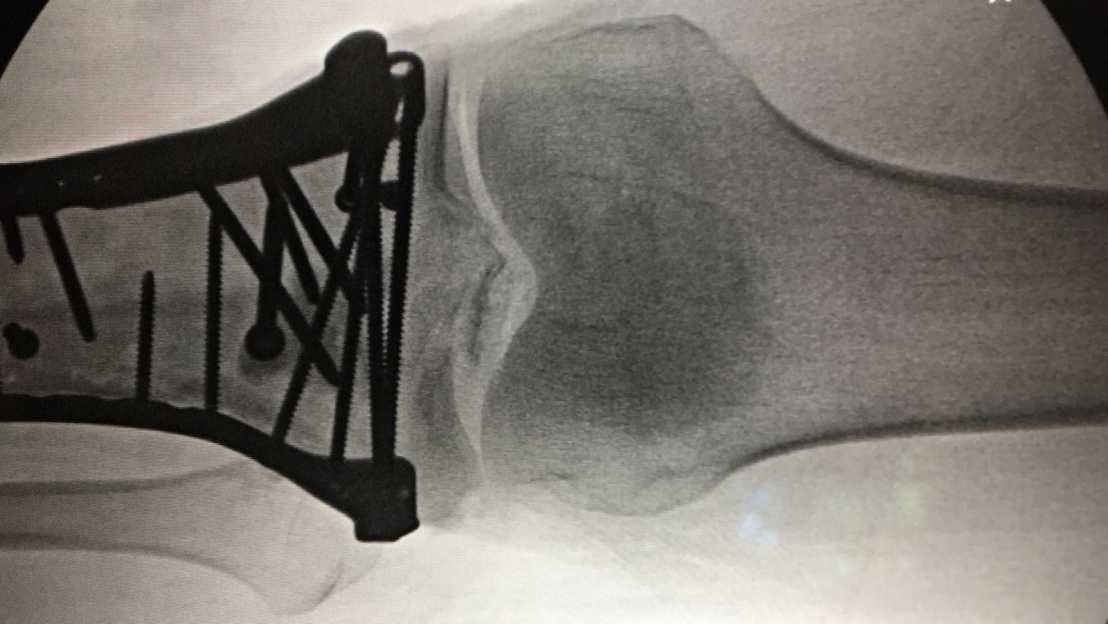 Enlarged view: X-ray image of a shin fracture directly below the knee joint: such complicated screw connections are to be simplified in the future. (Photograph: courtesy of T. Zumbrunn)