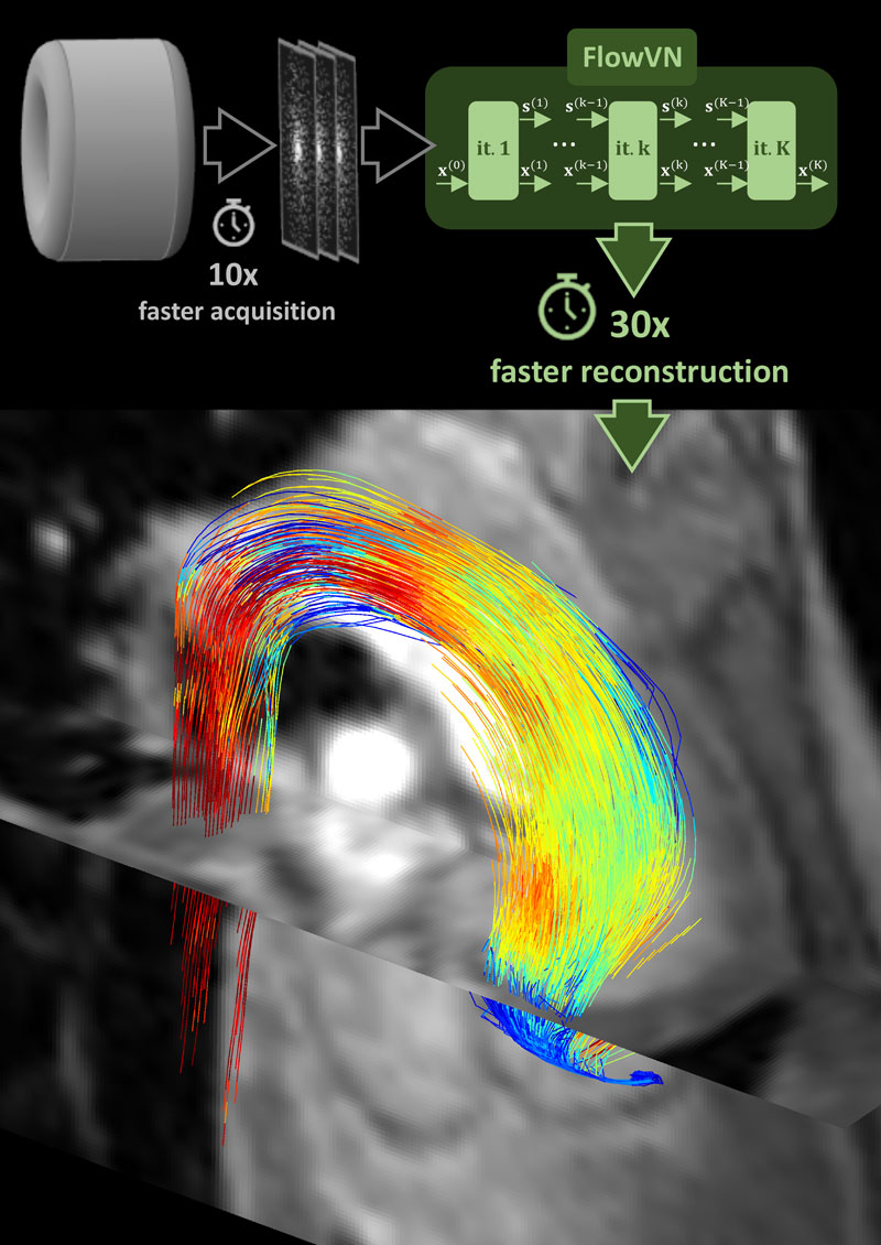 The new MRI method makes it possible to obtain precise MRI images of blood flow in less than five minutes instead of 30 minutes as it is currently the case. (Visualization: CMR Zurich)