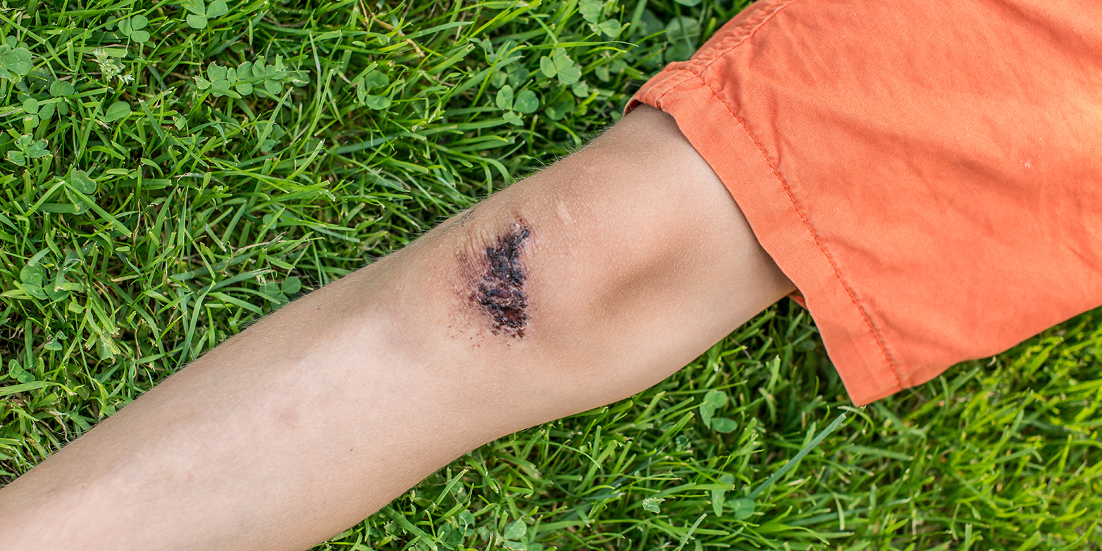 Quickly it happened that children scraped their knee. ETH researchers have now taken a closer look at how the wound heals. (Photograph: Colourbox)