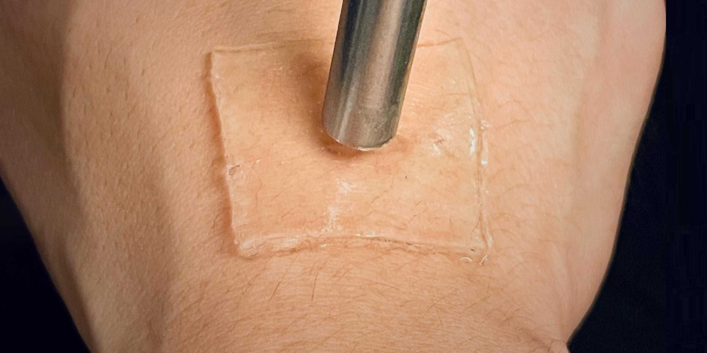 Ultrasound can be used to anchor the gel patch strongly to the skin.  