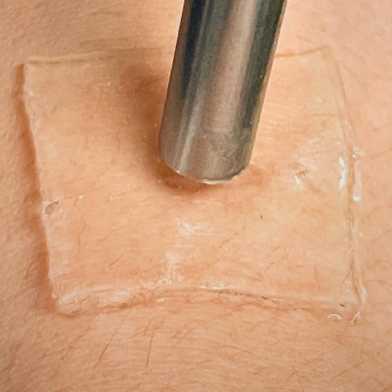 Ultrasound can be used to anchor the gel patch strongly to the skin