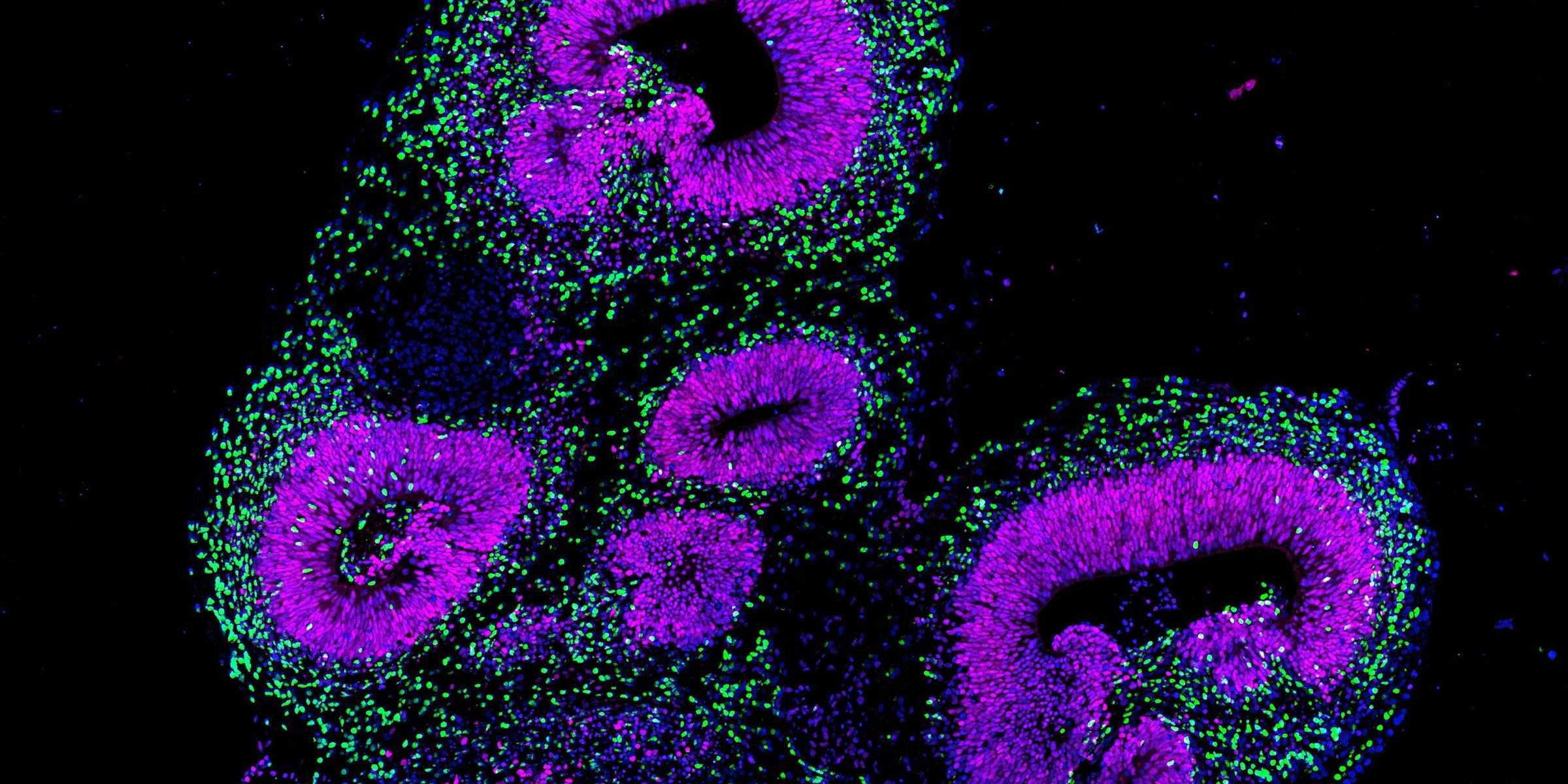 Brain organoid from human stem cells under the fluorescence microscope: the protein GLI3 is stained purple and marks neuronal precursor cells in forebrain regions of the organoid. Neurons are stained green.