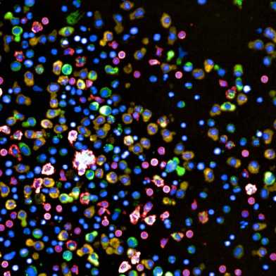 Close-up image of cells from a bone-marrow biopsy
