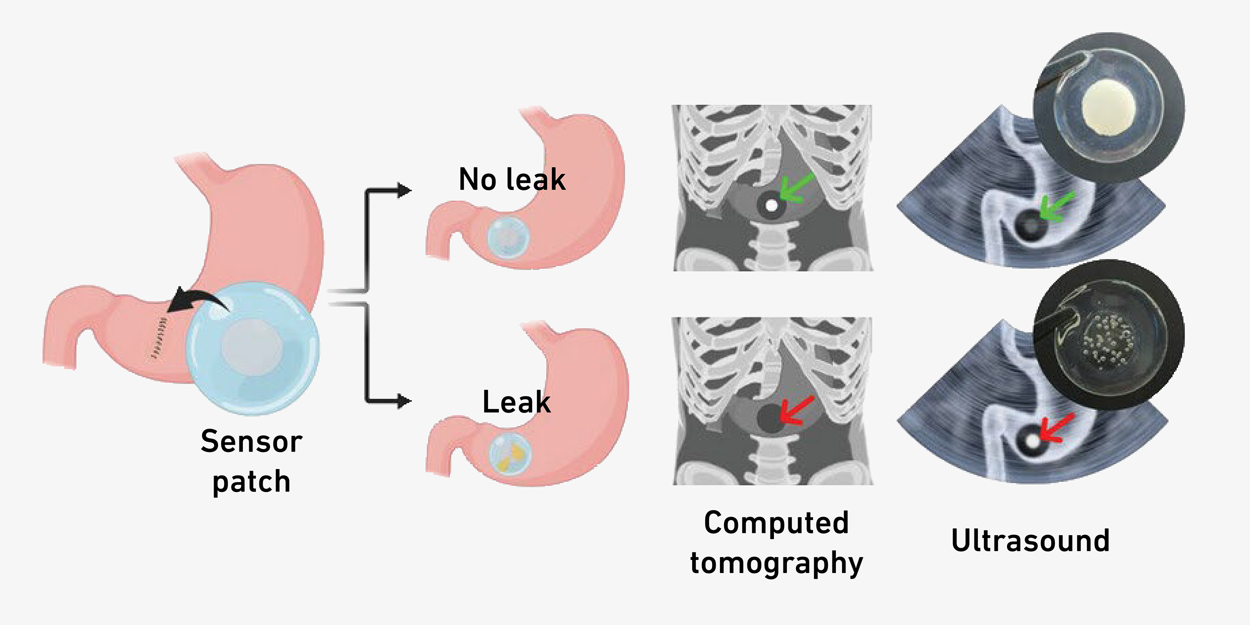 Enlarged view: Schematic representation of stomach with leak and stomach without leak.
