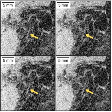 Images of a conventional computed tomography and images of the new grating interferometry computed tomographym, which are shown side by side for comparison. A particular evident feature is marked with a yellow arrow.