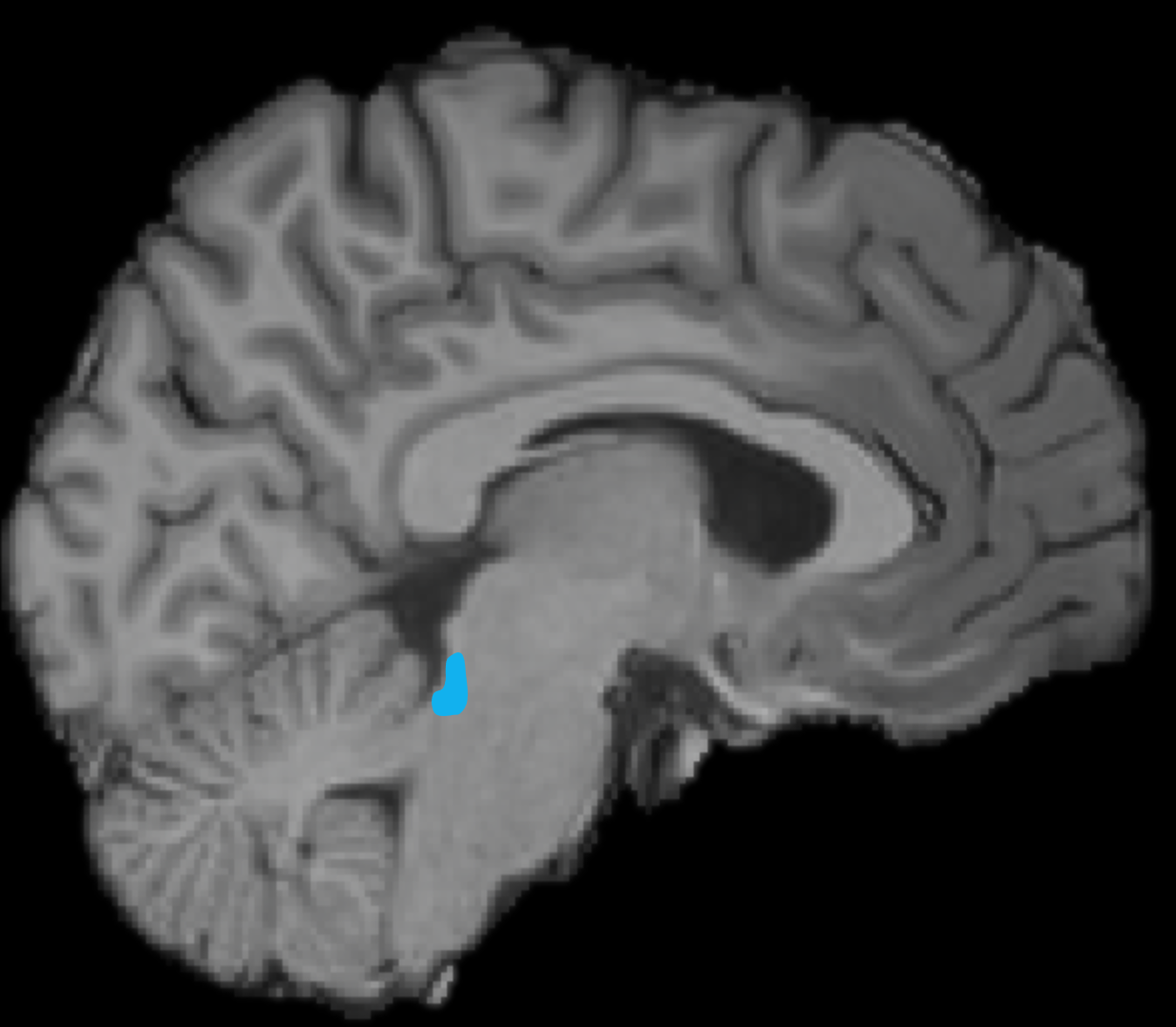 Enlarged view: MRI of a brain, a small area (in the lower half of the brain in the center) is marked in blue.