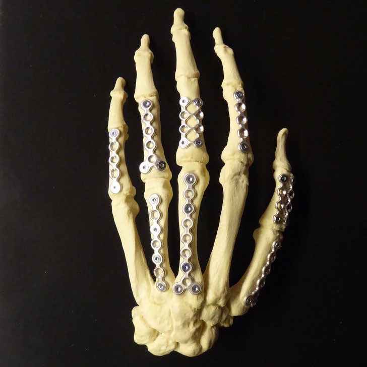 Hand with implants